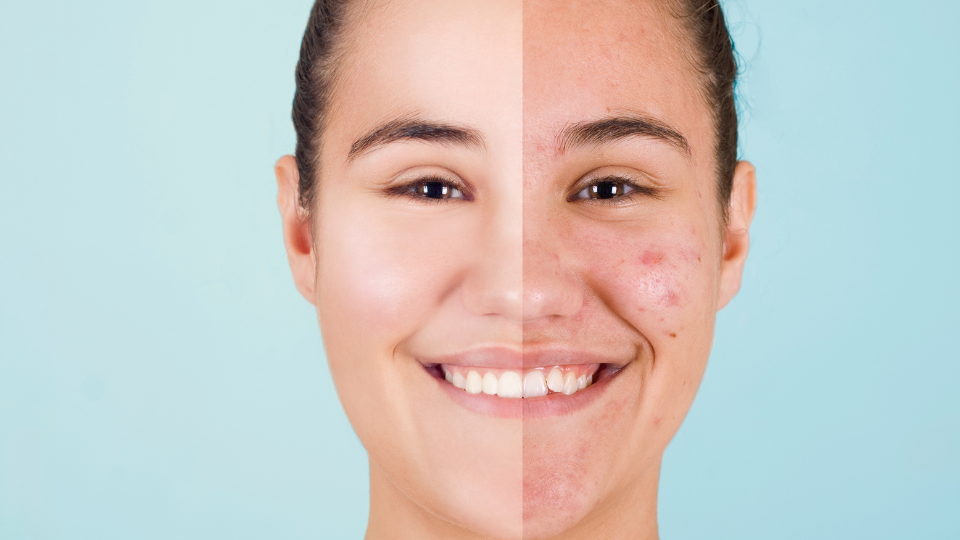 Acne Treatment